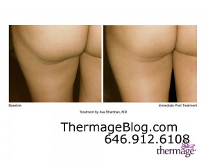 Buttocks Thermage
