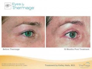 Video thumbnail for youtube video Thermage Treatment for 'Dooping' or 'Baggy' Eyelids - Thermage Blog