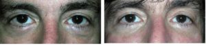 Eyes Before and After Carboxytheray