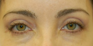 4-eyes-blephupfema2