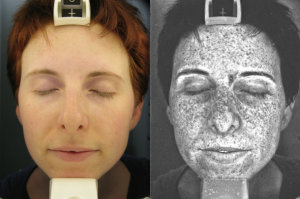 A 35-year-old melanoma survivor agrees to share photos that Dellavalle's team took comparing her skin under normal light and ultraviolet light. (Credit: University of Colorado Cancer Center) 